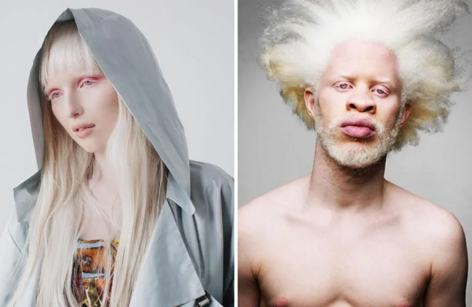 Em alguns lugares do mundo o albinismo uma verdadeira maldio