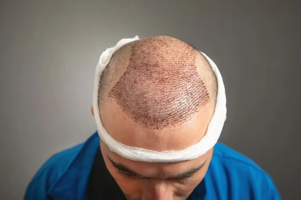 Como a Turquia se tornou um dos principais destinos para transplantes capilares