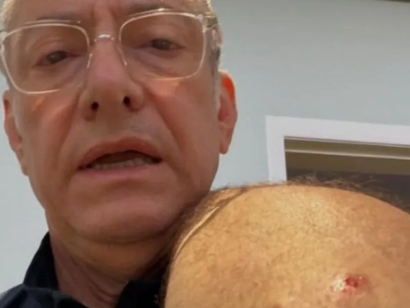 Jornalista José Roberto Burnier é atacado por pitbull sem guia e desabafa: “Irresponsabilidade”