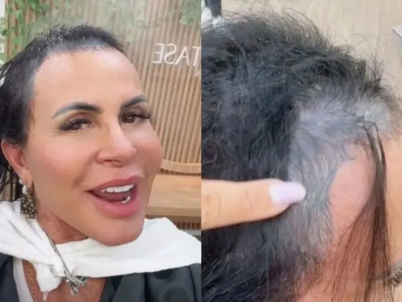 Gretchen mostra recuperação após transplante capilar: “Olha como estou bem”