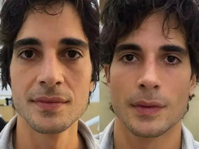 Fiuk faz harmonização facial e revela ‘antes e depois’